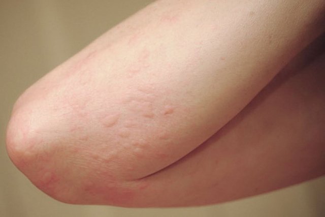 Vắc-xin viêm gan A cho người lớn