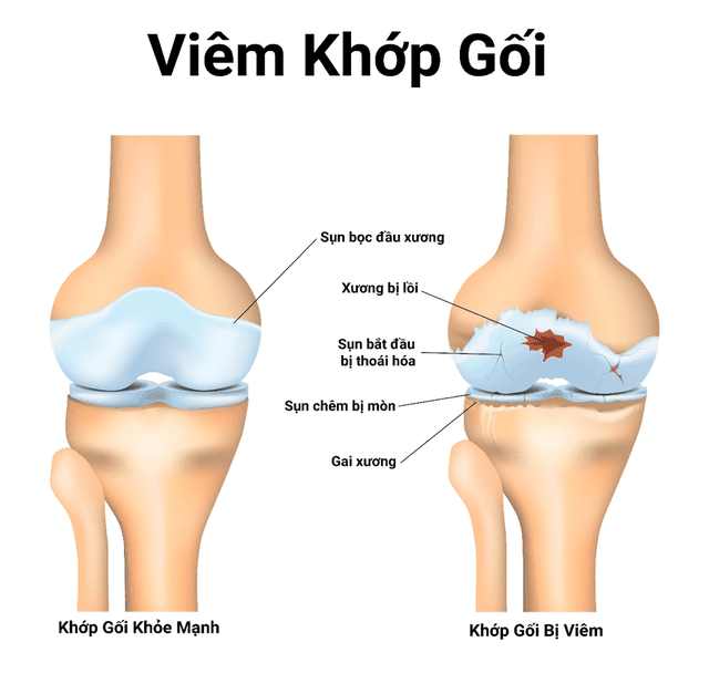 Các vấn đề thường gặp ở khớp gối