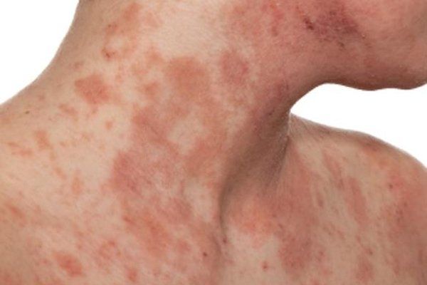 Dị ứng đậu phộng có nguy hiểm?