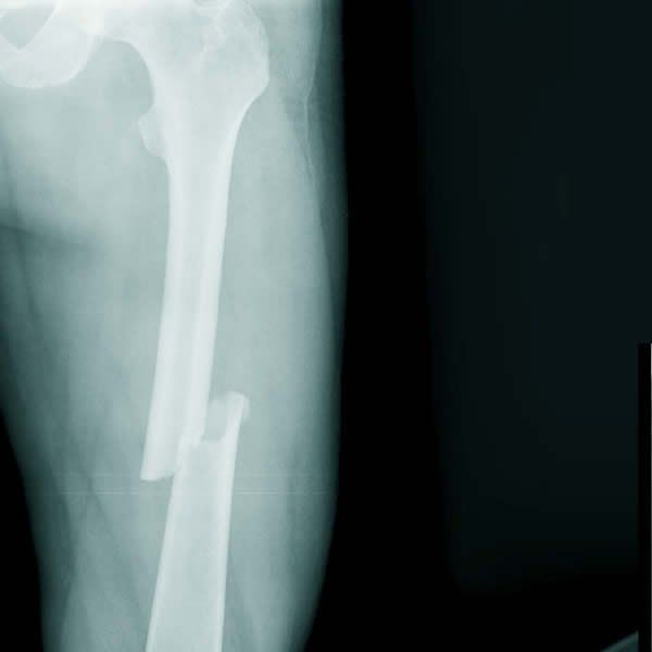 Vai trò của X quang trong chẩn đoán bệnh lý khớp gối