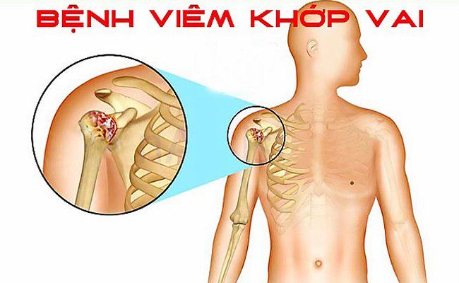 Vai trò của X quang trong chẩn đoán và điều trị viêm quanh khớp vai