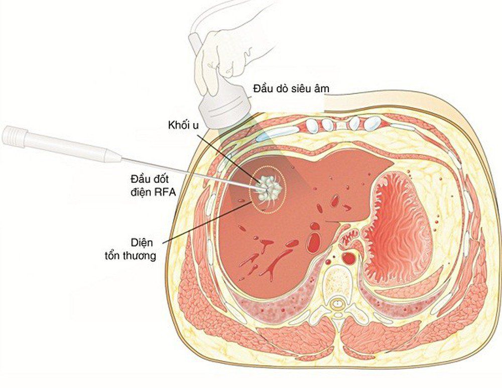 Thế nào là bệnh u gan đa ổ?