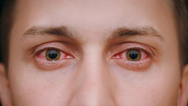 Bệnh do nhiễm Chlamydia Trachomatis sinh dục – tiết niệu