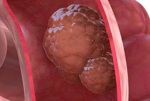 Các loại polyp đại trực tràng thường gặp