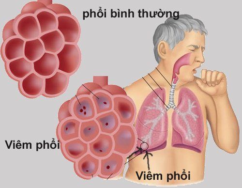 Các loại viêm phổi thường gặp