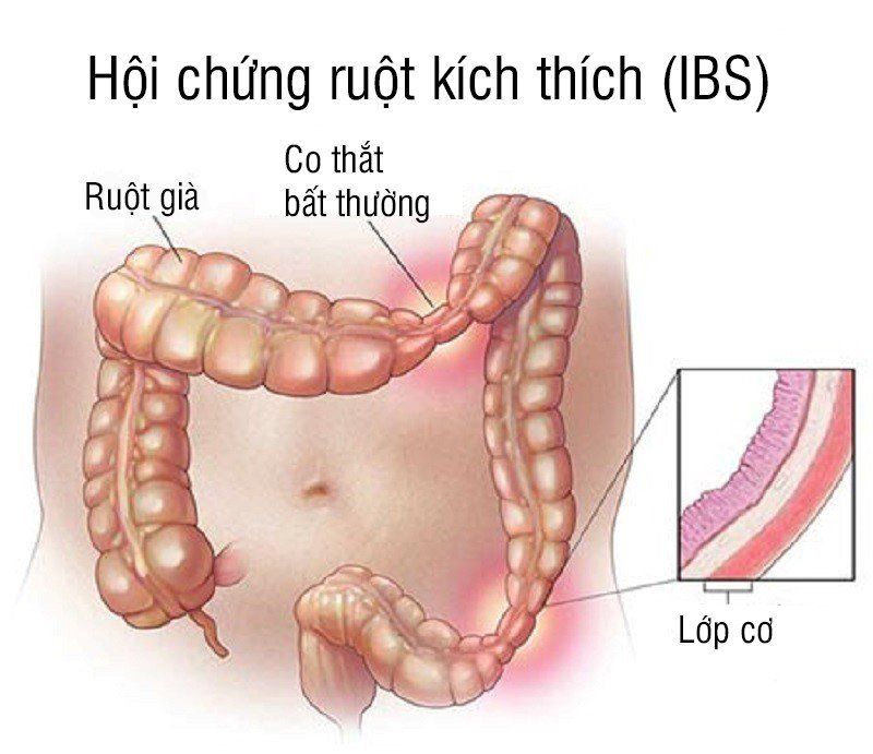 Tiêu chảy buổi sáng - Nguyên nhân và cách điều trị