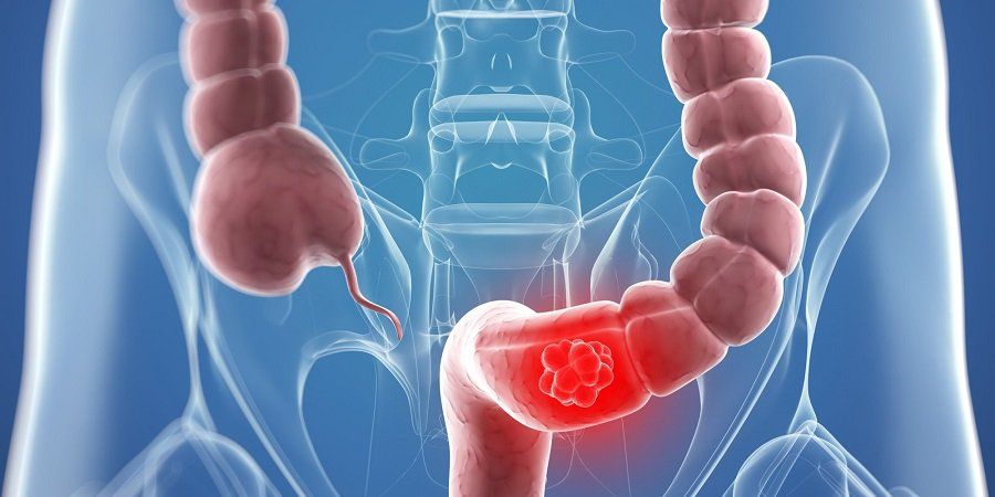 Polyp đại tràng và diễn biến thành ung thư