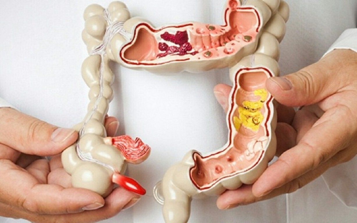 Những loại polyp đại tràng nào dễ tiến triển thành ung thư?