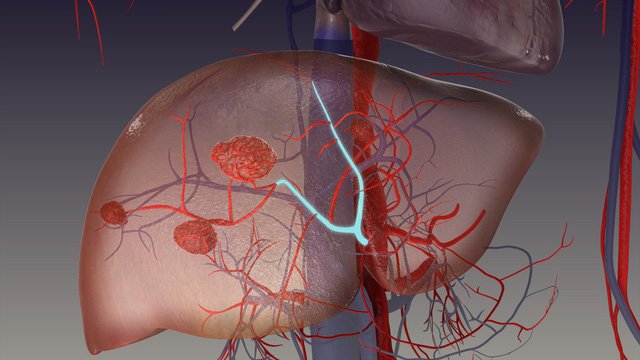 Có cách nào phòng ngừa hemangioma gan không?
