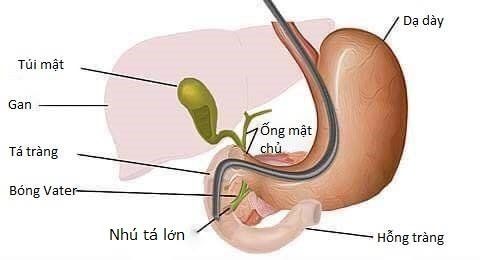 Nội soi mật tụy ngược dòng được thực hiện như thế nào?