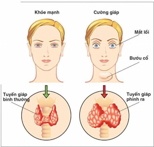 Dấu hiệu cảnh báo các vấn đề về tuyến giáp