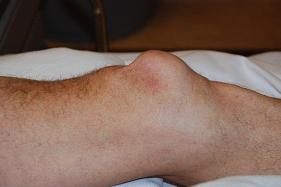 Tìm hiểu bệnh u nang bao hoạt dịch khớp gối