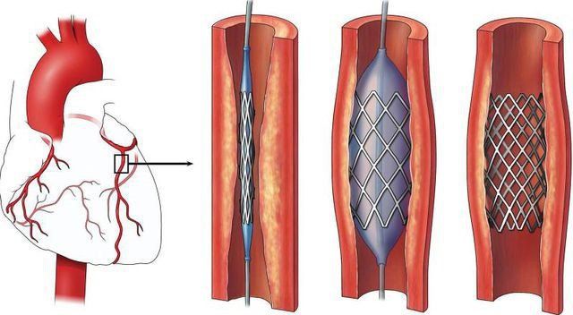 Những rủi ro khi đặt stent mạch vành