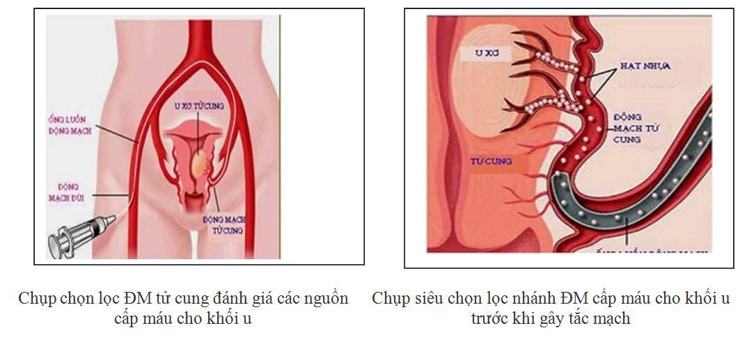 U xơ tử cung kích thước thế nào có thể nút mạch, không cần mổ?