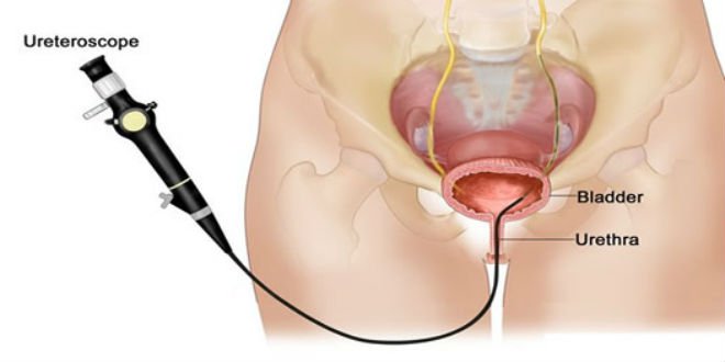 Siêu âm viêm bàng quang có mất thời gian bao lâu và cần chuẩn bị như thế nào trước khi thực hiện?
