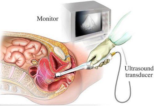 Vai trò của siêu âm đầu dò âm đạo trong chẩn đoán bệnh lý phụ khoa