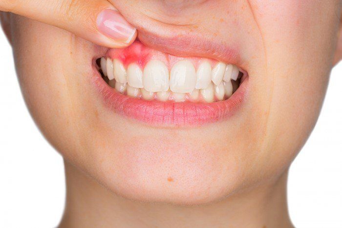 Làm thế nào để trị dứt điểm nhức răng sau sinh?