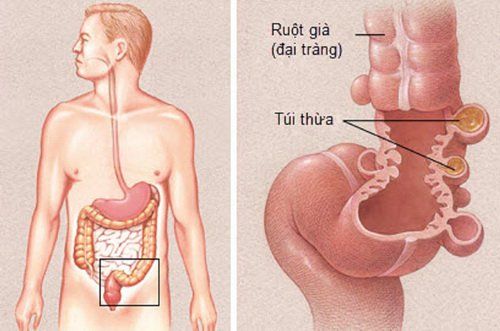 Viêm túi thừa đại tràng: Mổ hay không?