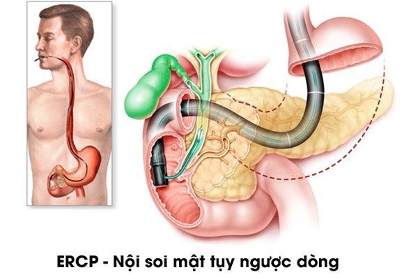 Ưu điểm của nội soi mật tụy ngược dòng (ERCP)