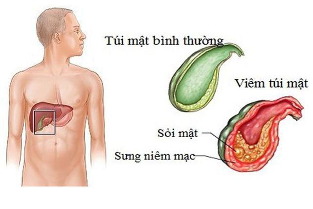 Các mức độ viêm túi mật cấp tính và biện pháp chẩn đoán