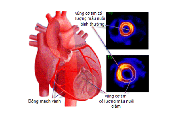 3 loại xạ hình tim mạch thường gặp