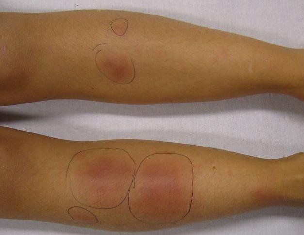 Các nguyên nhân gây bệnh xơ cứng bì