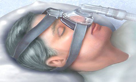 Thở áp lực dương liên tục trong điều trị suy hô hấp