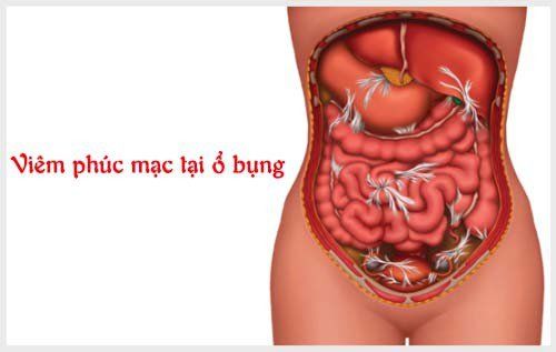 Viêm phúc mạc cấp: Những điều cần biết