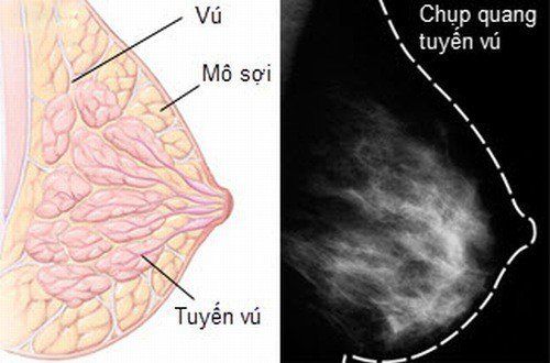 U sợi tuyến vú lành tính có cần phẫu thuật?