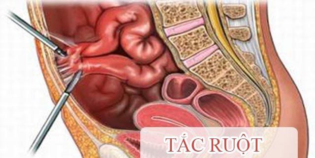 Mở thông hỗng tràng hoặc mở thông hồi tràng để nuôi ăn