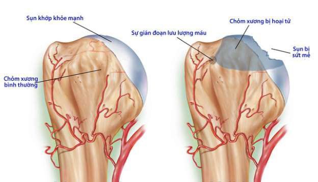 Những kỹ thuật y tế nào giúp chẩn đoán gãy xương hông?
