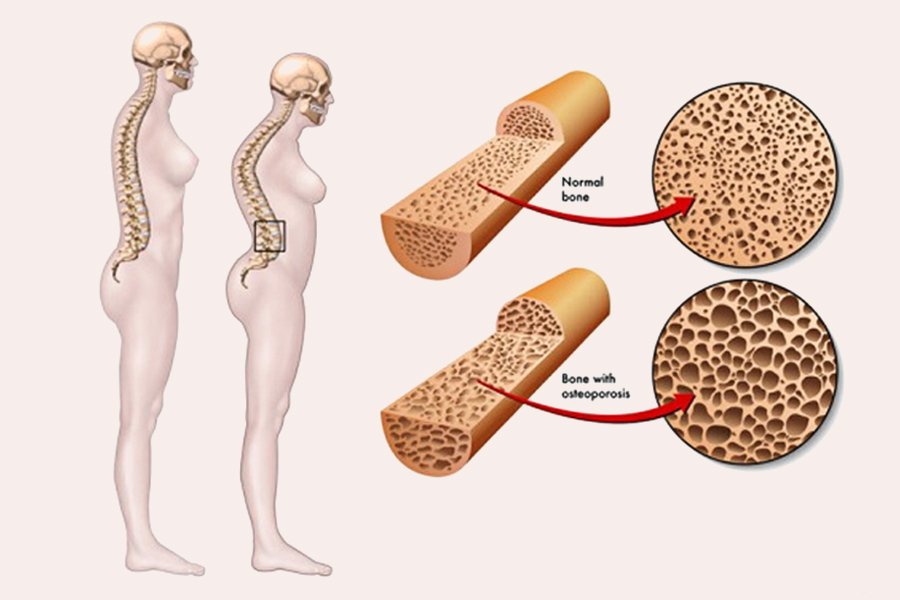 Phim X-quang có thể được sử dụng như thế nào để chẩn đoán viêm khớp dạng thấp?
