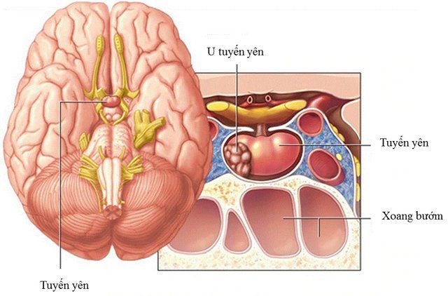 Phẫu thuật nội soi cắt bỏ u tuyến yên: Chỉ định khi nào?