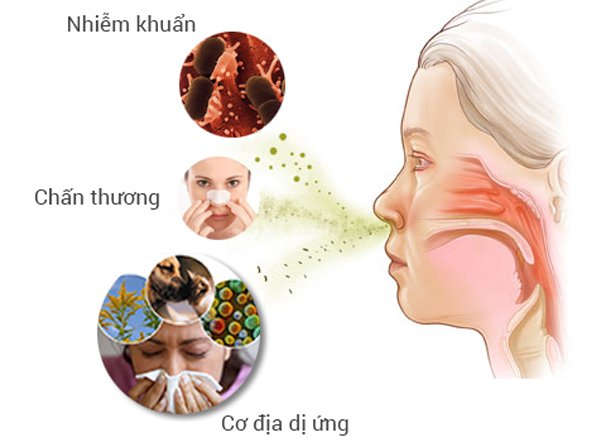 Viêm mũi dị ứng do phấn hoa
