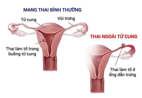 Các biến chứng có thể gặp sau mổ thai ngoài tử cung