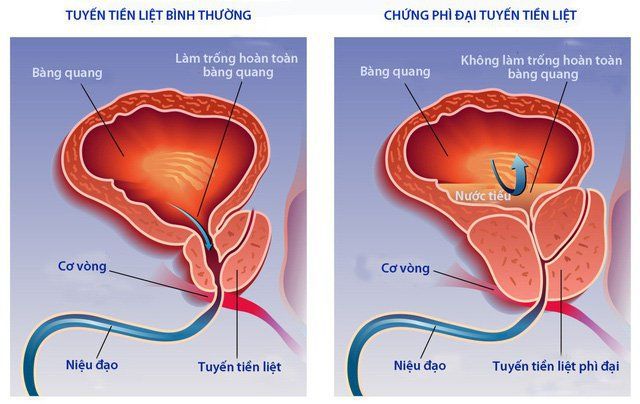 Chẩn đoán phì đại lành tính tiền liệt tuyến trên siêu âm qua trực tràng