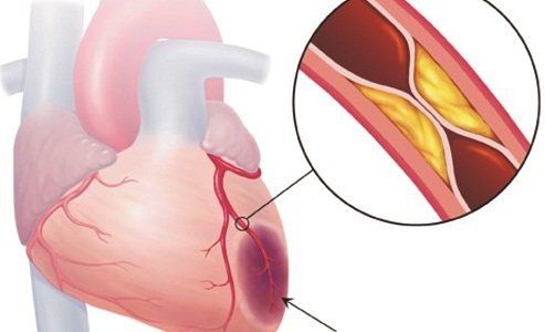 Suy tim tâm trương: Những điều cần biết