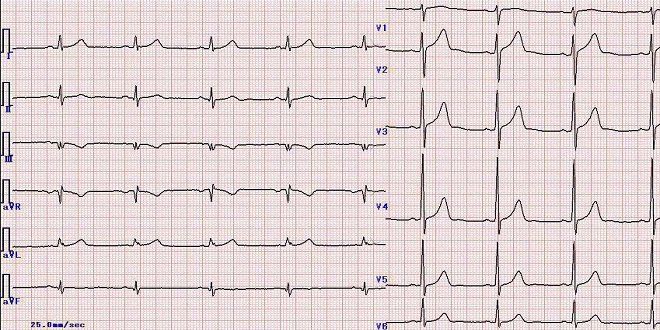 Viêm màng ngoài tim cấp: Những điều cần biết