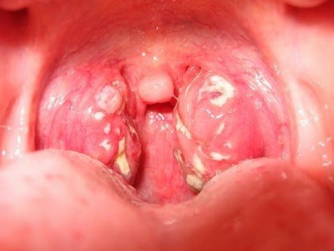 Mổ nội soi viêm amidan có nguy hiểm không?