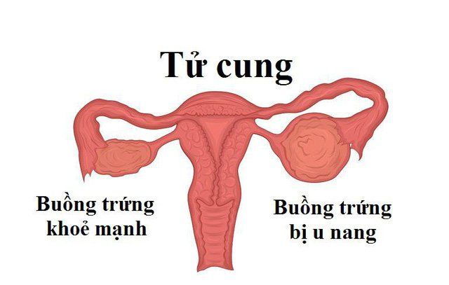 Gây tê tủy sống phẫu thuật cắt u nang buồng trứng