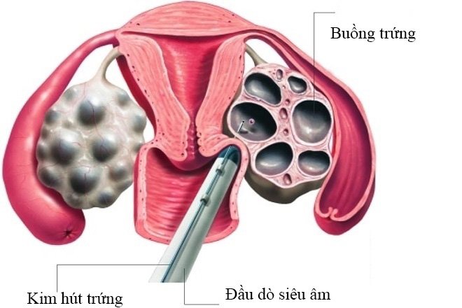 Theo dõi nang noãn khi thực hiện IVF