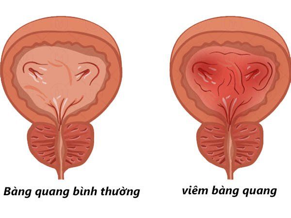 Dày thành bàng quang trên siêu âm nói lên điều gì?