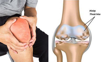 Nội soi rửa khớp gối trước và trong phẫu thuật