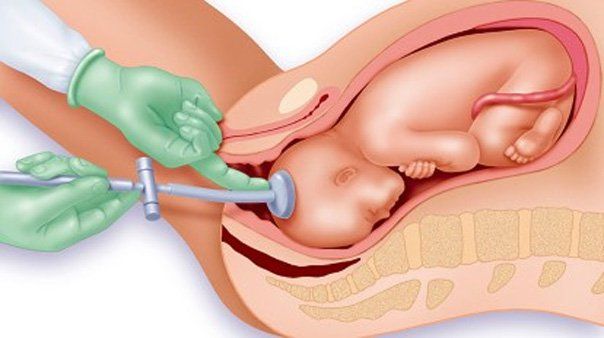 Sinh con bằng giác hút có ảnh hưởng gì đến trẻ?