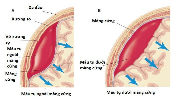 Những điều cần biết về cấp cứu chấn thương sọ não