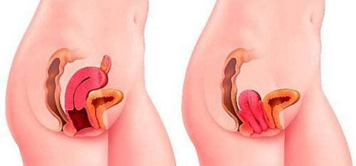 Vòng nâng cổ tử cung trong điều trị bệnh lý sàn chậu