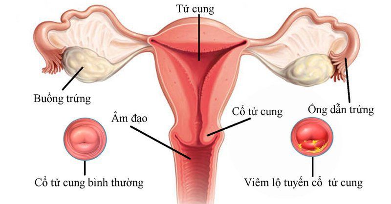 Soi cổ tử cung giúp phát hiện sớm ung thư cổ tử cung