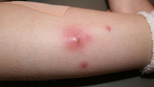 Các vấn đề bạn cần biết về mụn nhọt