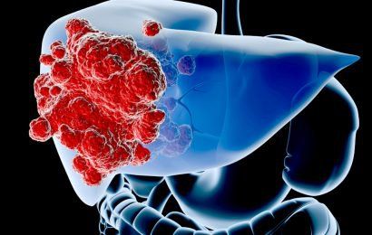 Phẫu thuật nội soi cắt gan: Những điều cần biết