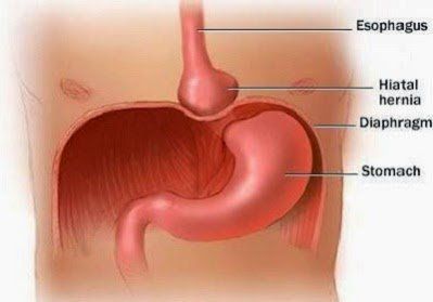 Phục hồi sau nội soi điều trị thoát vị hoành